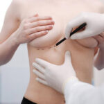 breast reconstruction in Sydney