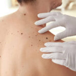 skin cancer surgery
